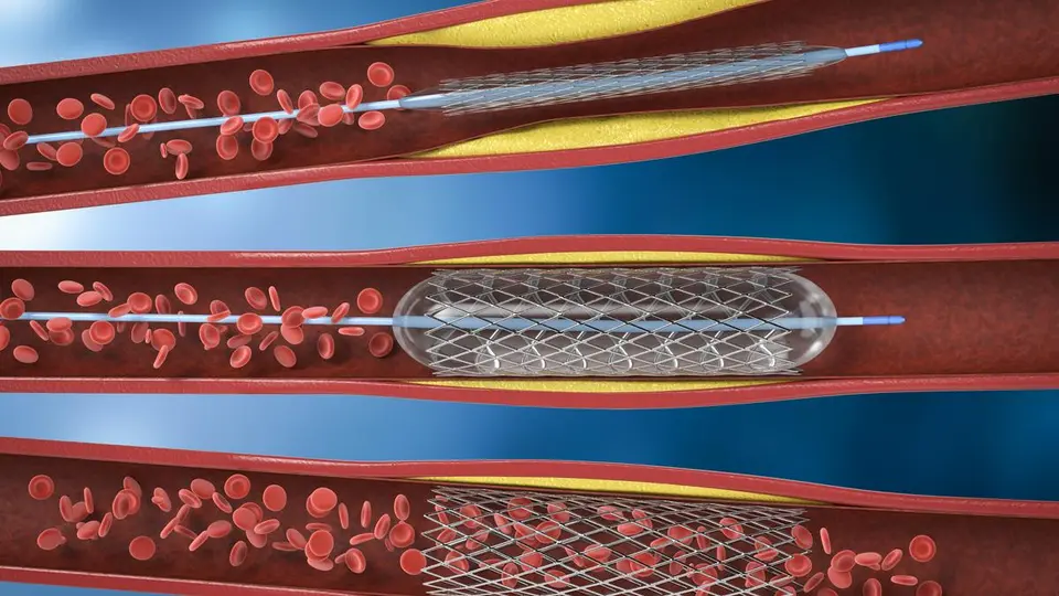 Are coronary stents necessary?